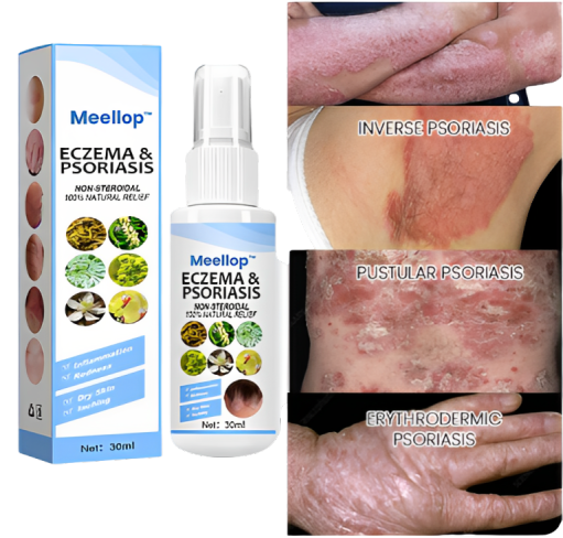 Herbal Psoriasis Relief Spray 🔥 Buy 1 Get 1 Free 🔥