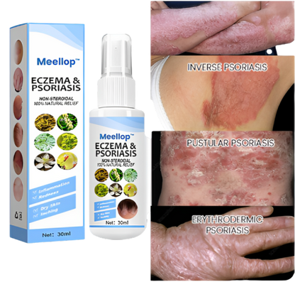 Herbal Psoriasis Relief Spray 🔥 Buy 1 Get 1 Free 🔥